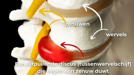 uitpuilende discus tegen zenuw in de rug